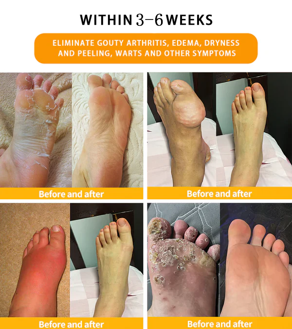 Piguiay®GLP-1 Slimming& Detox Foot Bath Beads-🌿(𝐋𝐀𝐍𝐀 𝐂𝐞𝐫𝐭𝐢𝐟𝐢𝐜𝐚𝐭𝐢𝐨𝐧，𝗟𝘆𝗺𝗽𝗵𝗮𝘁𝗶𝗰 𝗔𝘀𝘀𝗼𝗰𝗶𝗮𝘁𝗶𝗼𝗻 𝗼𝗳 𝐂𝐚𝐧𝐚𝐝𝐚)